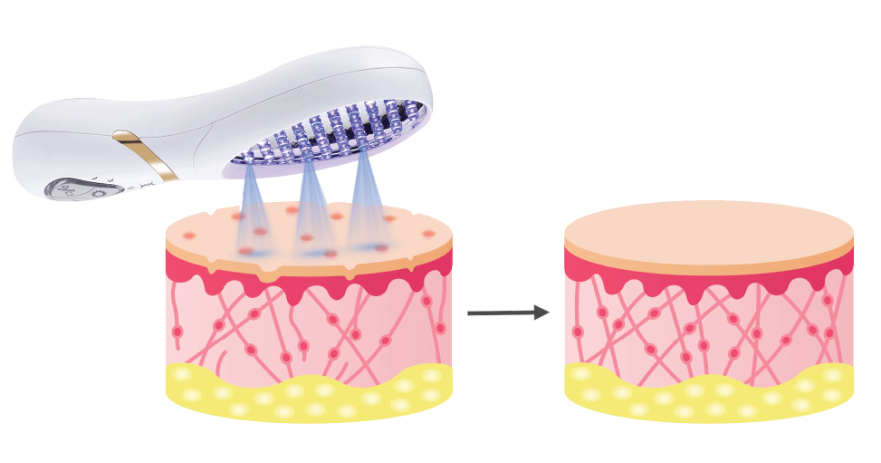 Blue LED Light Therapy 1