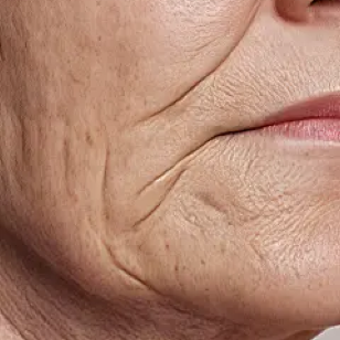Nasolabial folds1